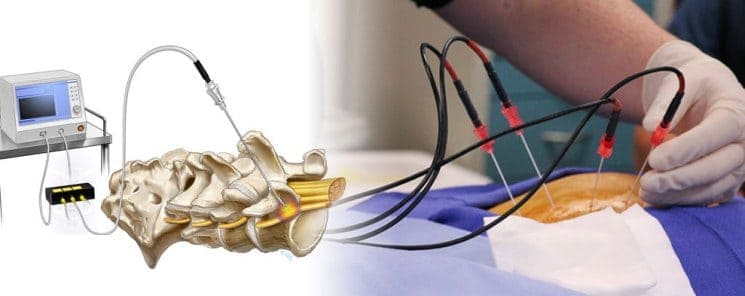 How Radiofrequency Ablation Works: Insights into the Procedure and Results